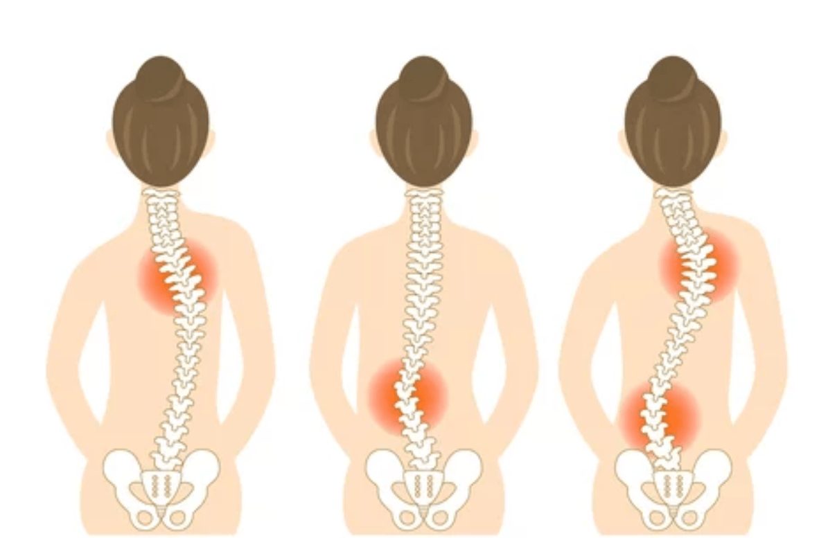 Fisioterapia Para El Tratamiento De La Escoliosis Clínica Fisami 1820